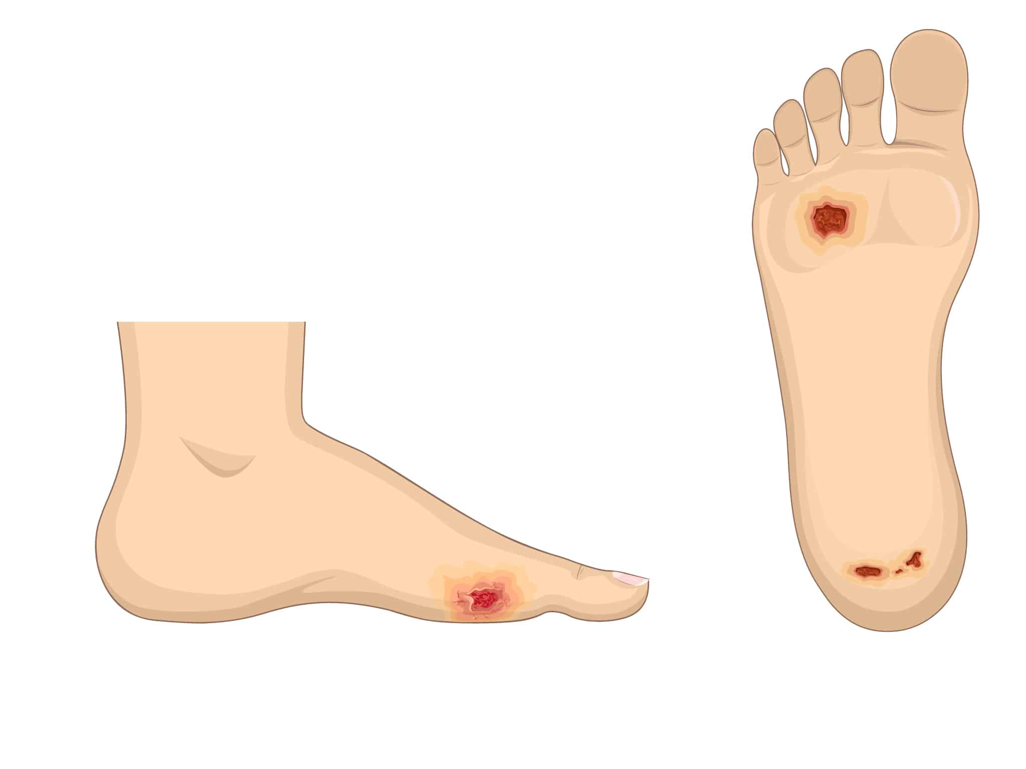 Diabetische voet